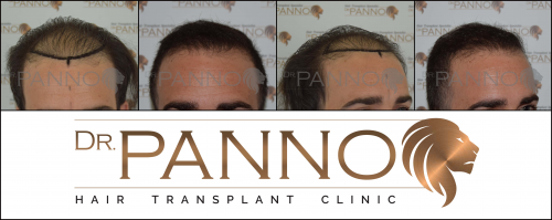 Foto Cl�nica de Trasplante Capilar Dr. Panno