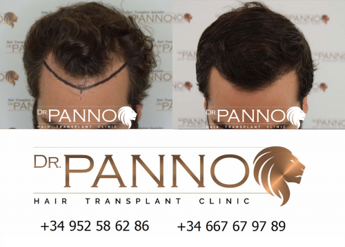 Foto Cl�nica de Trasplante Capilar Dr. Panno