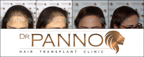 Foto Cl�nica de Trasplante Capilar Dr. Panno