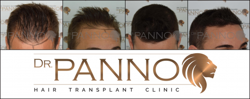 Foto Cl�nica de Trasplante Capilar Dr. Panno