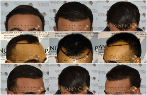 Foto Cl�nica de Trasplante Capilar Dr. Panno