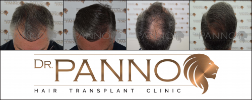 Foto Cl�nica de Trasplante Capilar Dr. Panno