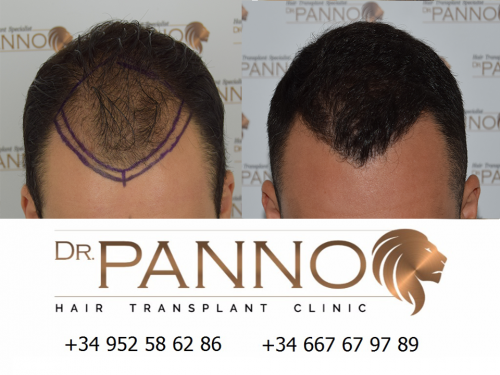 Foto Cl�nica de Trasplante Capilar Dr. Panno