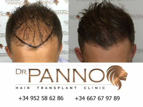 Foto Cl�nica de Trasplante Capilar Dr. Panno