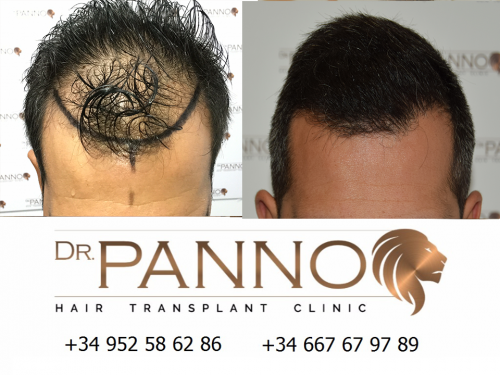 Foto Cl�nica de Trasplante Capilar Dr. Panno