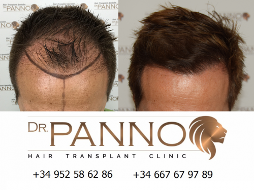 Foto Cl�nica de Trasplante Capilar Dr. Panno