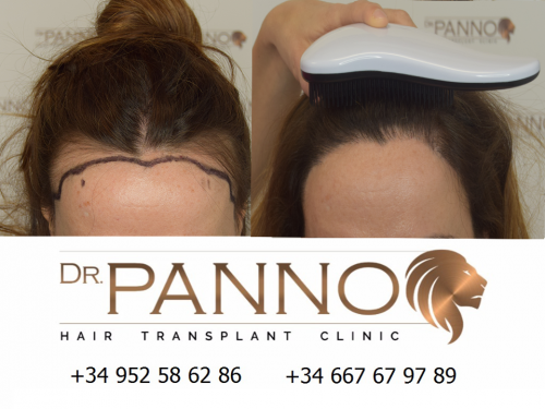 Foto Cl�nica de Trasplante Capilar Dr. Panno