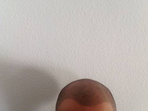 Micropigmentaci�n - alopecia