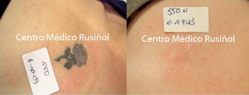 Eliminaci�n de tatuaje