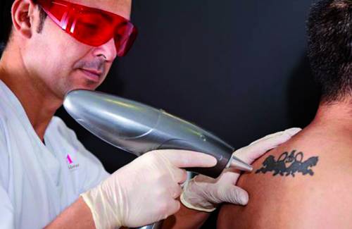 Medicina Estetica. Eliminacion de tatuajes