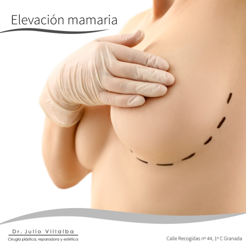 Elevaci�n Mamaria Granada