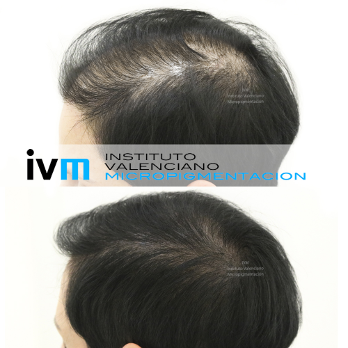 Tricopigmentaci�n