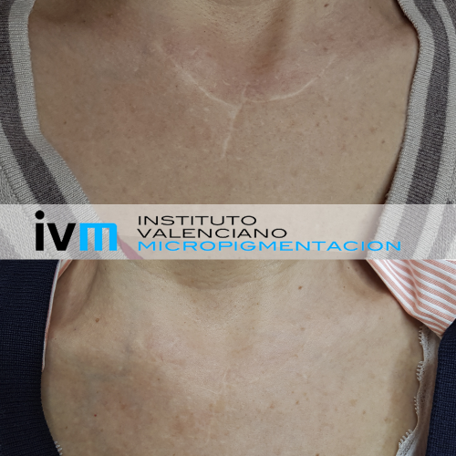 Micropigmentaci�n cicatriz