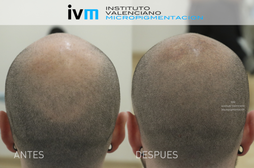 Tricopigmentaci�n