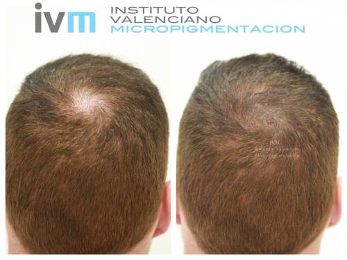 Foto INSTITUTO VALENCIANO MICROPIGMENTACION