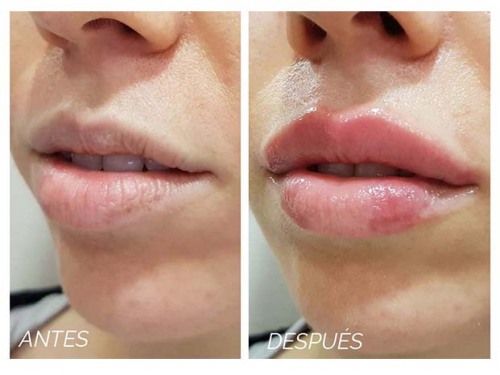 Aumento de Labios 2