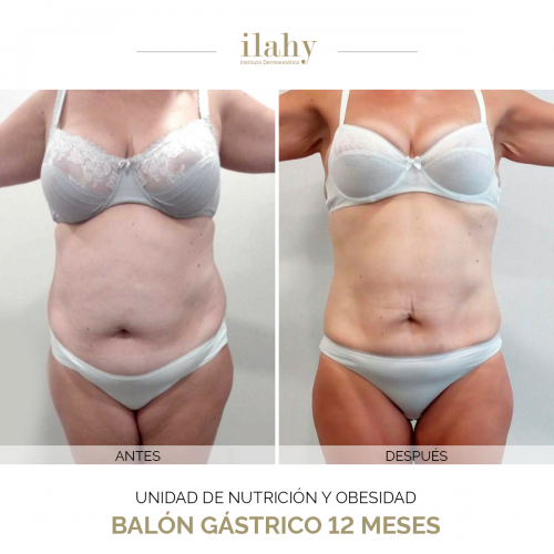 Bal�n G�strico - Caso de antes y despu�s