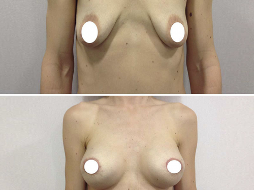 Antes y despu�s aumento de pecho