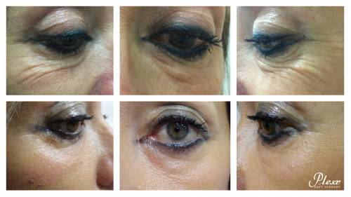 Rejuvenecimiento ojos