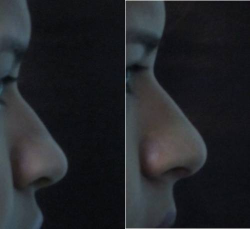 RINOPLASTIA SIN CIRUGIA