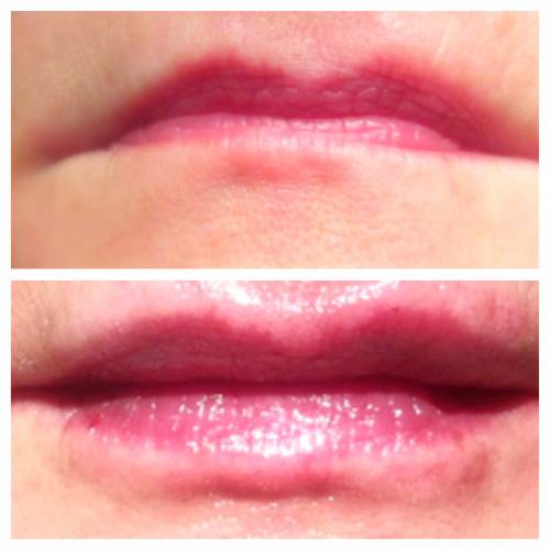 Perfilado+aumento labio