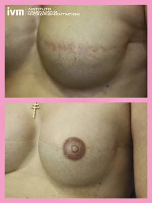 Reconstruccion conjunto areola/pezon