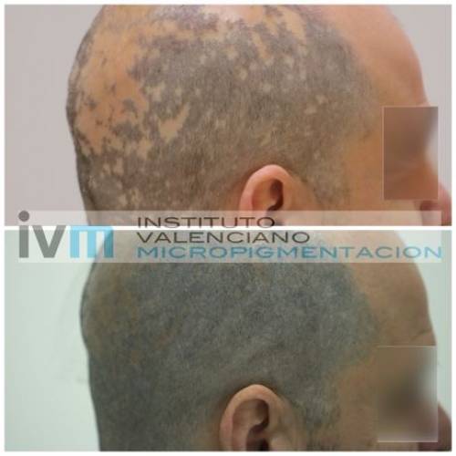 Micropigmentacion capilar en caso de alopecia areata