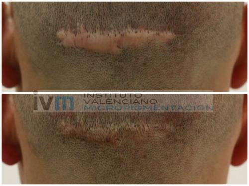 Camuflaje de cicatriz tras intervancion de microinjerto capilar