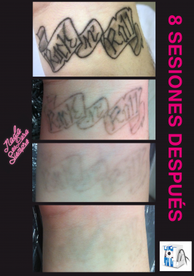 Elimaci�n tatuajes con l�ser.