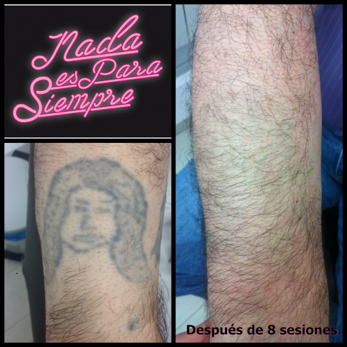 Eliminaci�n tatuajes con Nd:Yag Q-Switch