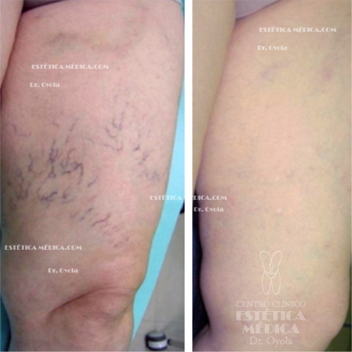 Tratamiento varices 01