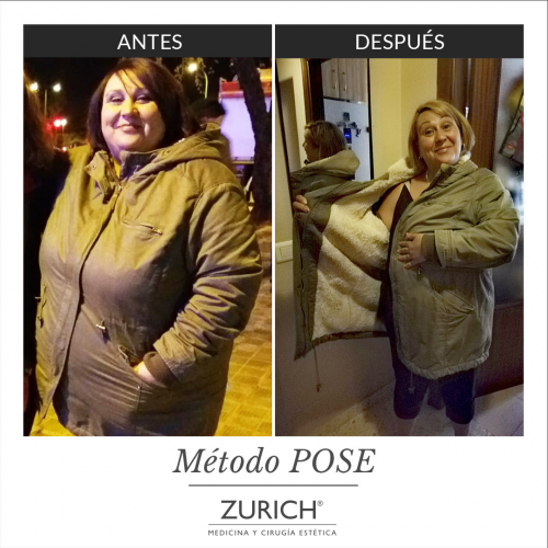 Antes y despu�s � M�todo POSE
