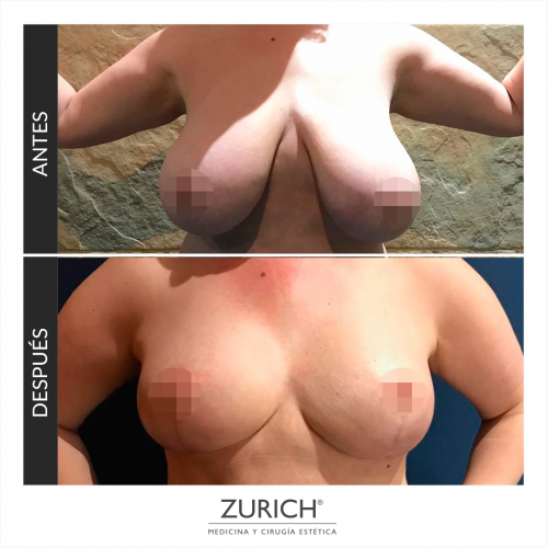 Mamoplastia de reducci�n