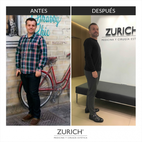 Antes y despu�s � Bal�n G�strico � 12 meses