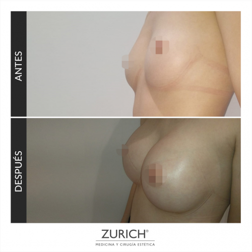 Antes y despues �Aumento de pecho