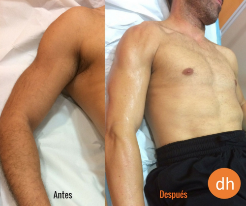 Depilaci�n L�ser