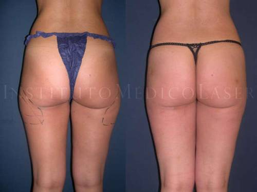 Lipol�ser - Antes y Despu�s