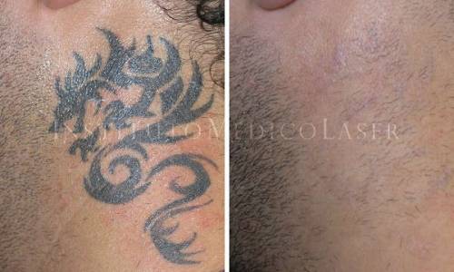 Tatuajes - Antes y Despu�s