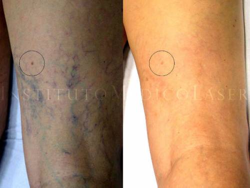Varices - Antes y Despu�s
