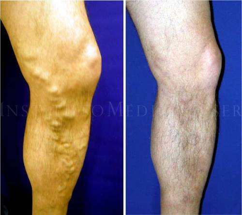 Varices graves - Antes y Despu�s