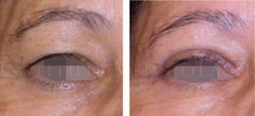 Blefaroplastia - Antes y Despu�s (I)