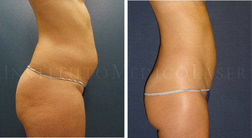 Lipo Vaser + Renuvion - Antes y despu�s