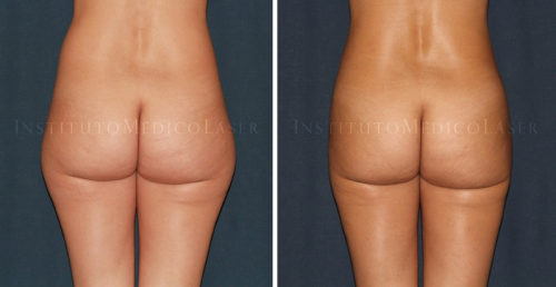 Antes y despu�s de LipoVaser y Renuvion en caderas