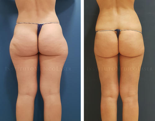 Lipo IML (Vaser+Renuvion) - Antes y despu�s