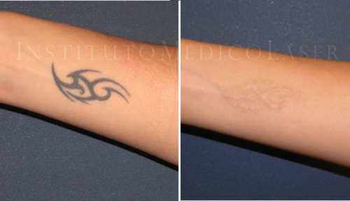 Tatuajes con L�ser