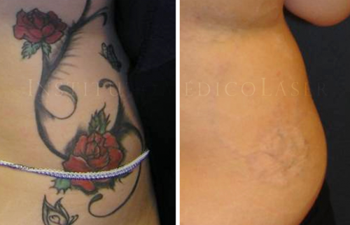 Eliminaci�n de tatuajes con color