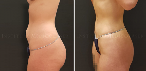 Lipo IML en abdomen