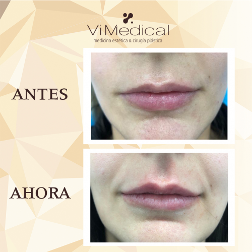 Correccion de asimetr�a y pilares de labio superior.