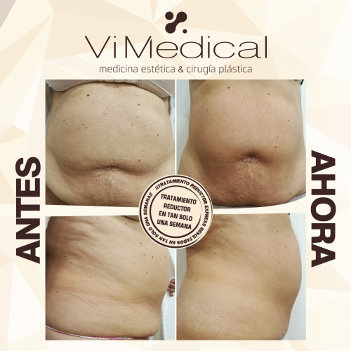 Tratamiento Reductor