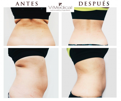 Tratamiento reductor